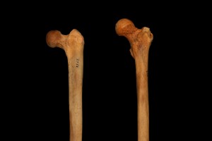 femur inclination